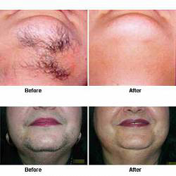 از تیغ تا لیزر برای رفع موهای زائد ،کدام موقت و دائمی است؟