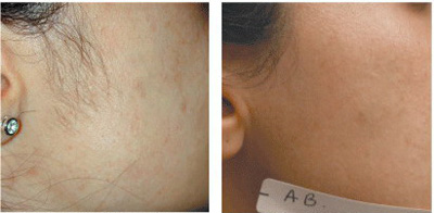 از تیغ تا لیزر برای رفع موهای زائد ،کدام موقت و دائمی است؟