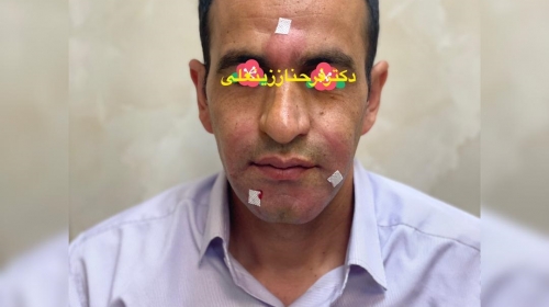 نکاتی در مورد تزریق چربی در افراد لاغر