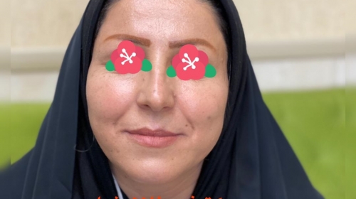 چند نمونه از هزاران مورد تزریق چربی بعد از چندماه از تزریق
